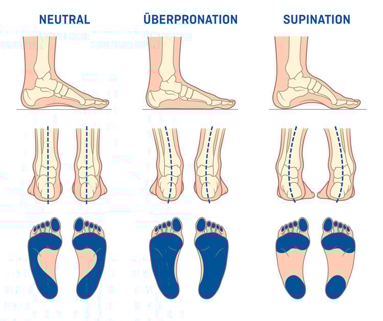 Pronationstypen Darstellung von drei Fußstellungen: Neutral, Überpronation und Supination. Jede Haltung wird mit drei Ansichten gezeigt – Seitenansicht der Fußknochen, Rückansicht mit Ausrichtung von Sprunggelenk und Ferse sowie Fußabdruck zur Druckverteilung. Neutral zeigt eine ausgeglichene Ausrichtung, Überpronation eine Einwärtsdrehung mit Druck auf der Innenseite, Supination eine Auswärtsdrehung mit Druck auf der Außenseite